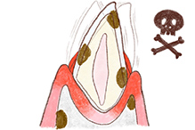 犬の歯の断面図3